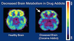 Image result for Addiction Pathophysiology