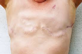 Image result for Mastectomy