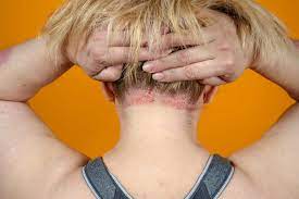 Hair loss as a symptom of thyroid problems. Is Vitamin D Deficiency The Reason For Your Flaky Scalp Hellogiggles