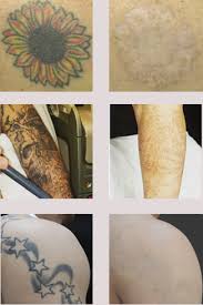 Laser Tattoo Removal Salt Lake City Silkey Skin Md Dermatology Aesthetics Kaysville Ut