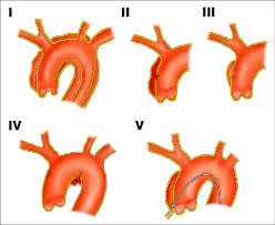 I think his reviews are primarily from patients who are. Svensson Classification 6 I Classic Aortic Dissection With Intimal Download Scientific Diagram