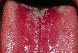 How long does novel coronavirus. Oral Thrush In Children Treatment Causes Symptoms Signs