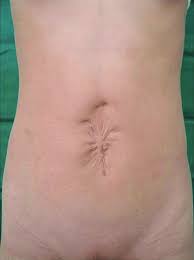 Image result for Umbilicus
