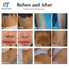 Most laser hair removal devices need to be plugged into a wall point, making it difficult to maneuver around certain areas on your body. Alma Soprano Titanium 808 Diode Laser Hair Removal Machine China Alma Soprano Titanium 808 Diode Laser Hair Removal Made In China Com