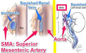 16 Nutcracker Syndrome Ideas Syndrome Nutcracker Superior Mesenteric Artery