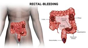 Image result for blood in stool human poop