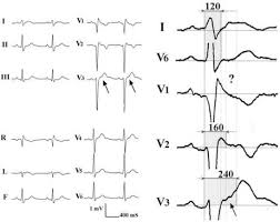 Image result for Epsilon Wave