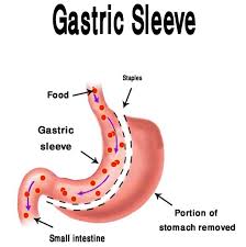Gastric Sleeve Surgery Sleeve Surgery Gastric Sleeve Gastric Sleeve Surgery