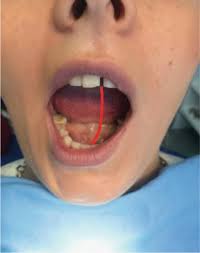 Structural And Functional Disorders Of The Temporomandibular Joint Internal Disorders Intechopen