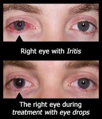 Pin On Iritis Anterior Uveitis