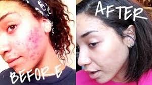 Get the basics on this skin condition from the experts at webmd. My Skin Care Routine For Severe Acne 2013 Youtube