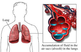 Factori precipitanti ai edemului pulmonar acut. Edem Pulmonar Asociat Cu Hipertensiune Danihilldesign Com