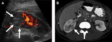 Image result for Acute Pyelonephritis