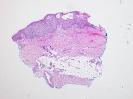 Clinical characteristics and endoscopic features were retrospectively reviewed and categorized. Pathology Outlines Herpes Simplex Zoster