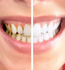 Image result for Tooth Discoloration