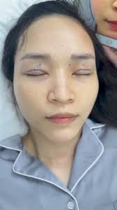 [Trực tiếp] Kết quả cắt mí của...