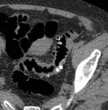 This can lead to symptoms that are similar to colon cancer symptoms, such as severe abdominal pain, changes in bowel habits, and rectal bleeding. Sigmoid Cancer Versus Chronic Diverticular Disease Differentiating Features At Ct Colonography Radiology