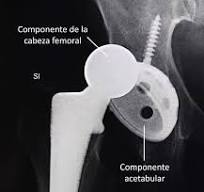 Reemplazo total de cadera (Total Hip Replacement ...