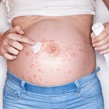 Dealing With Itching And Rashes During Pregnancy