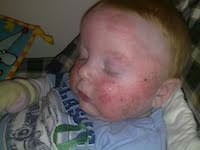 Leave it on and dress your. Coconut Oil And Eczema Scratch Pad National Eczema Association