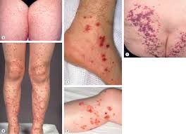 Image result for Vasculitis