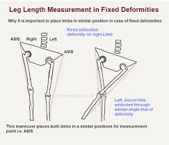 Image result for Functional Leg Length Discrepancy