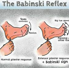 Image result for Babinski Reflex
