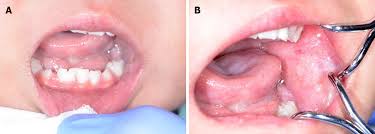 Image result for granuloma gum disease