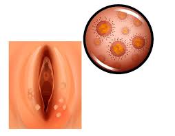 Image result for Vulvitis