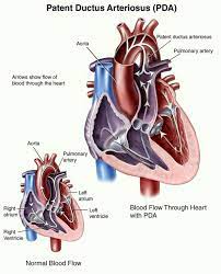 Patent Ductus Arteriosus Pda Patent Ductus Arteriosus Ductus Arteriosus Heart Disorders