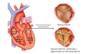 Estrechamiento anormal de una cavidad o canal corporal. Estenosis Aortica Que Sucede En La Estenosis Aortica Con La Sangre