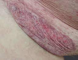 Common areas where the lymph nodes can be felt include the groin area, armpit, the neck, under the jaw and chin, behind the ears, and below the occiput (prominence on the back of the head). Erythematous Atrophic Plaque In The Inguinal Fold Mdedge Dermatology