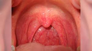 Image result for Strep throat infection roof of mouth