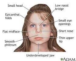 He has a flat facial profile; Fetal Alcohol Syndrome Facial Anatomy