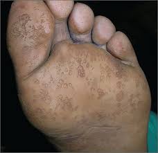 Image result for brown patches on the feet