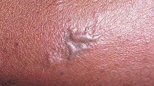 There are many differences between genital herpes and ingrown hairs. Is It Herpes Or Something Else Everyday Health