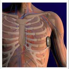 Mentre è disponibile anche un defibrillatore sottocutaneo che si impianta nella zona sottocostale sinistra ed il catetere sottocute, cioè al di fuori del cuore. Ad Ottobre Il Defibrillatore Senza Fili Il Dispari Quotidiano
