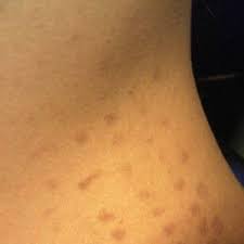 A large number of people undergo laser hair removal treatments every year all over the world with many suffering from minor or major laser hair removal burns which are not only painful but they can leave permanent scars too. How Long Do The Burn Spots Of Laser Hair Removal Stay On My Skin I Am So Worried Photo