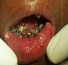 Image result for yellow tongue infection