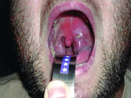 Image result for Peritonsillar Abscess