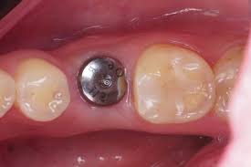 Image result for Alveolitis sicca)