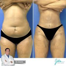 Pin On Amazing Lipo 360 Results At Jolie Plastic Surgery
