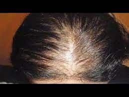 وصفات لعلاج الشعر الخفيف افضل طرق لعلاج الشعر الخفيف Brittle Hair Dry Brittle Hair Treatment