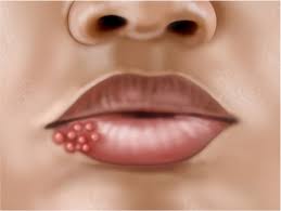 Syphilis is a sexually transmitted infection (sti) caused by a type of bacteria known as treponema pallidum. Secondary Syphilis Causes Symptoms Diagnosis