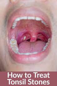 Salt water could dislodge bits of food from the crater while helping to soothe any discomfort caused by tonsillitis, which sometimes accompanies tonsil stones. Pin On Healthy Living
