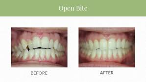 Most orthodontists will recommend removal of the wisdom teeth before beginning treatment. Clear Correct Vs Invisalign Which Is The Better Option 209 Nyc Dental