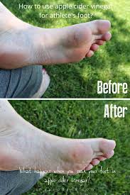 You can soak your feet in baking soda mixed with warm water, and this will soften the calluses. Apple Cider Vinegar Foot Soak What Happens If You Soak Your Feet In Acv Shopno Dana