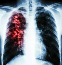 Image result for Pneumonia