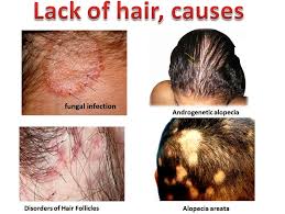 But we've done our scalp infection research and have solutions for the main type of fungal infection on the scalp that can cause hair loss comes from a class of fungi called dermatophytes—which cause ringworm. The Patient Who Loses Hair Causes