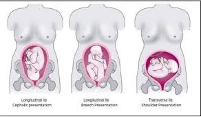Image result for Shoulder Presentation
